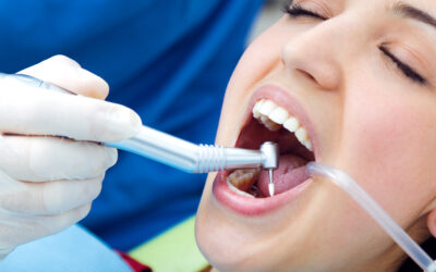 Tooth Decay & Fillings